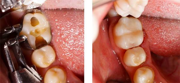 Before and after dental fillings