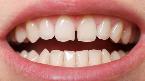 Prominent gap between teeth